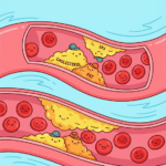 Let hier goed op! Zo waarschuwt je lichaam voor een te hoog cholesterol!